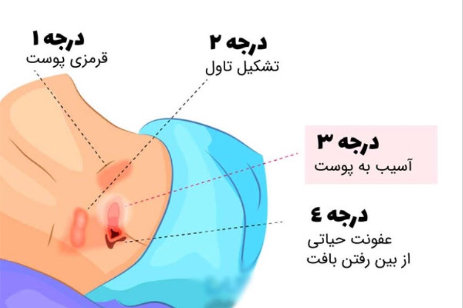 تصویر زخم بستر چیست؟ روش جلوگیری و بهترین روش های درمان آن