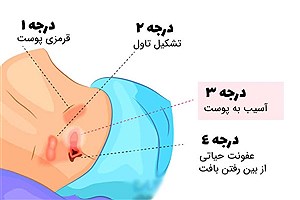 زخم بستر چیست؟ روش جلوگیری و بهترین روش های درمان آن