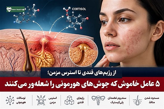 از رژیم‌های قندی تا استرس مزمن؛ ۵ عامل خاموش که جوش‌های هورمونی را شعله‌ور می‌کنند + روش‌های درمان ترکیبی