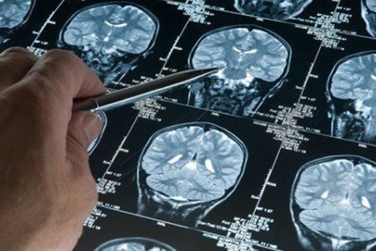 تصویر احتمال 3برابری مرگ کرونایی ها در اثر سکته مغزی