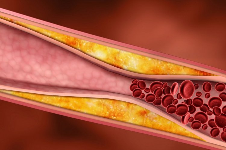 تصویر مهمترین نشانه های کلسترول خون
