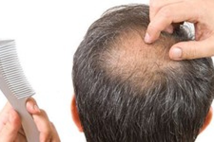 تصویر علت ریزش مو پس از ابتلا به کرونا