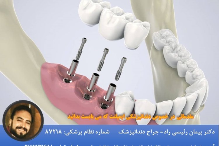 تصویر مقدماتی در خصوص دندانپزشکی ایمپلنت که می بایست بدانید