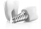 ایمپلنت دندان چیست ؟ (کاشت دندان طبیعی)